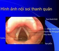 Nội Soi Thực Quản Ở Đâu